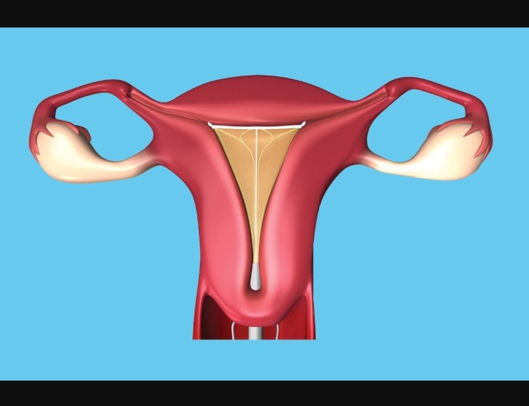 Novasure Endometrial Ablation